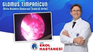 Glomus Timpanicun (Orta Kulakta Damarsal Tümöral Kitle)