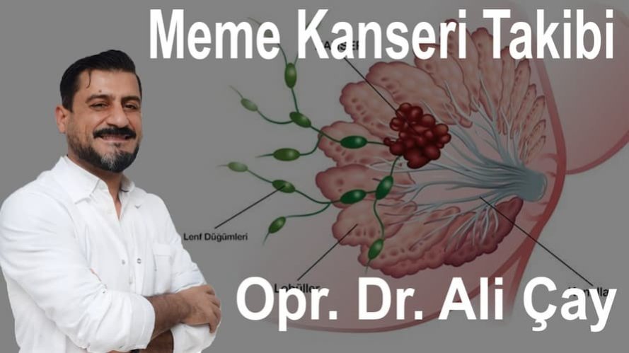 Meme Kanseri Takibi - Op. Dr. Ali Çay